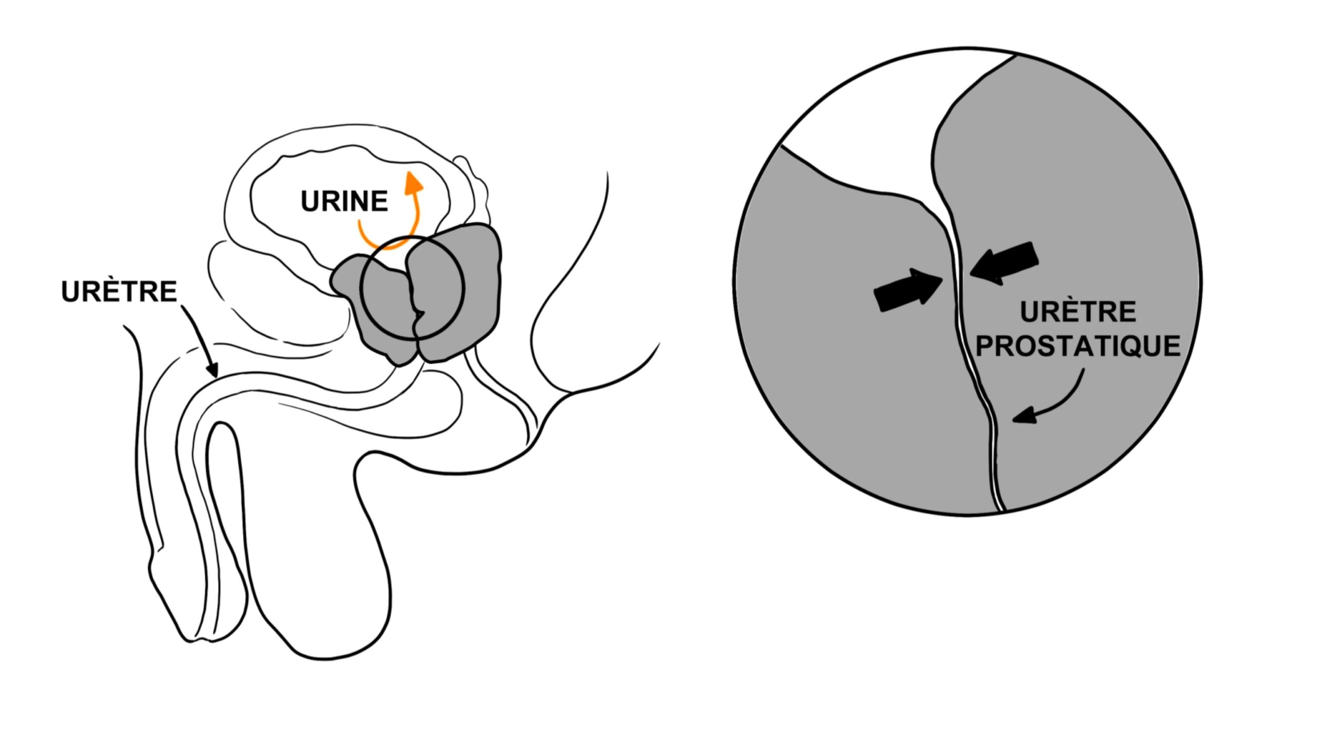 adenome de la prostate