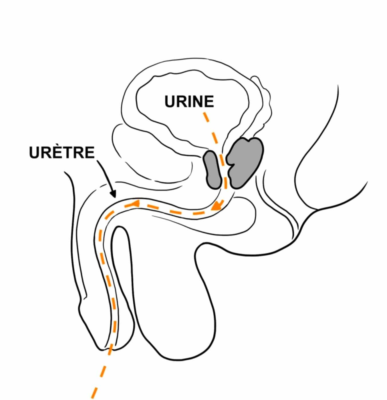 Adénome de la prostate symptômes, diagnostic et infos