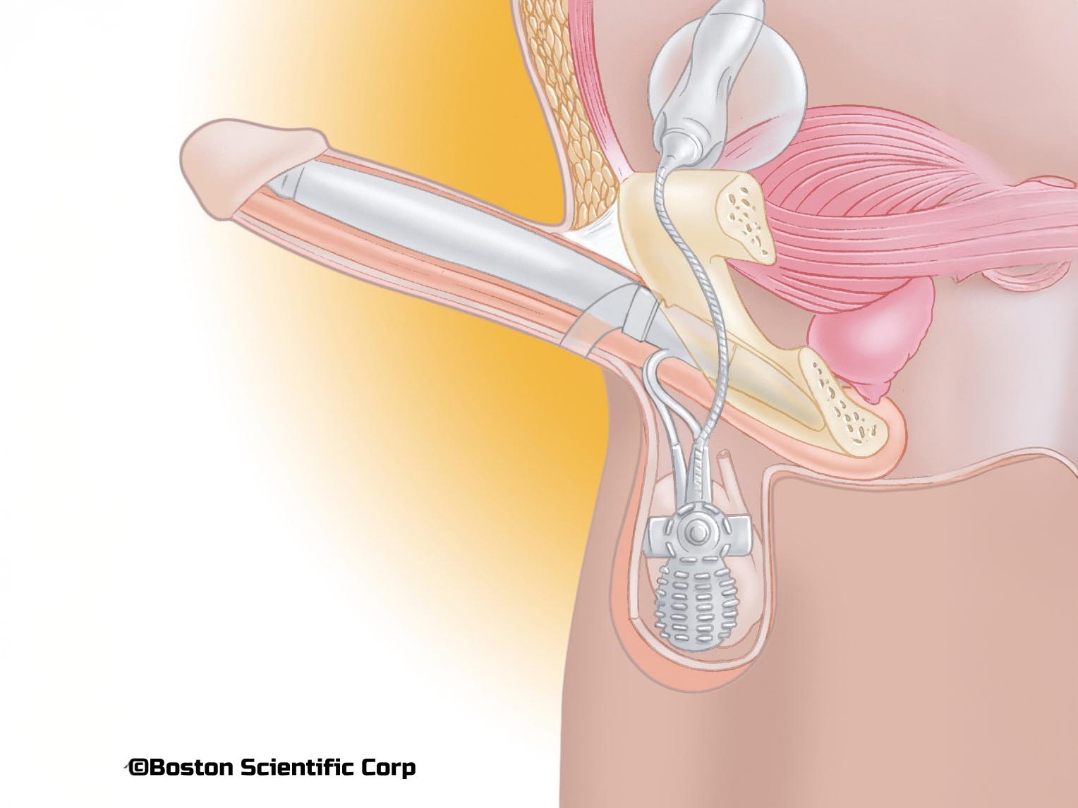 2 implant pénien gonflable ams 700 1
