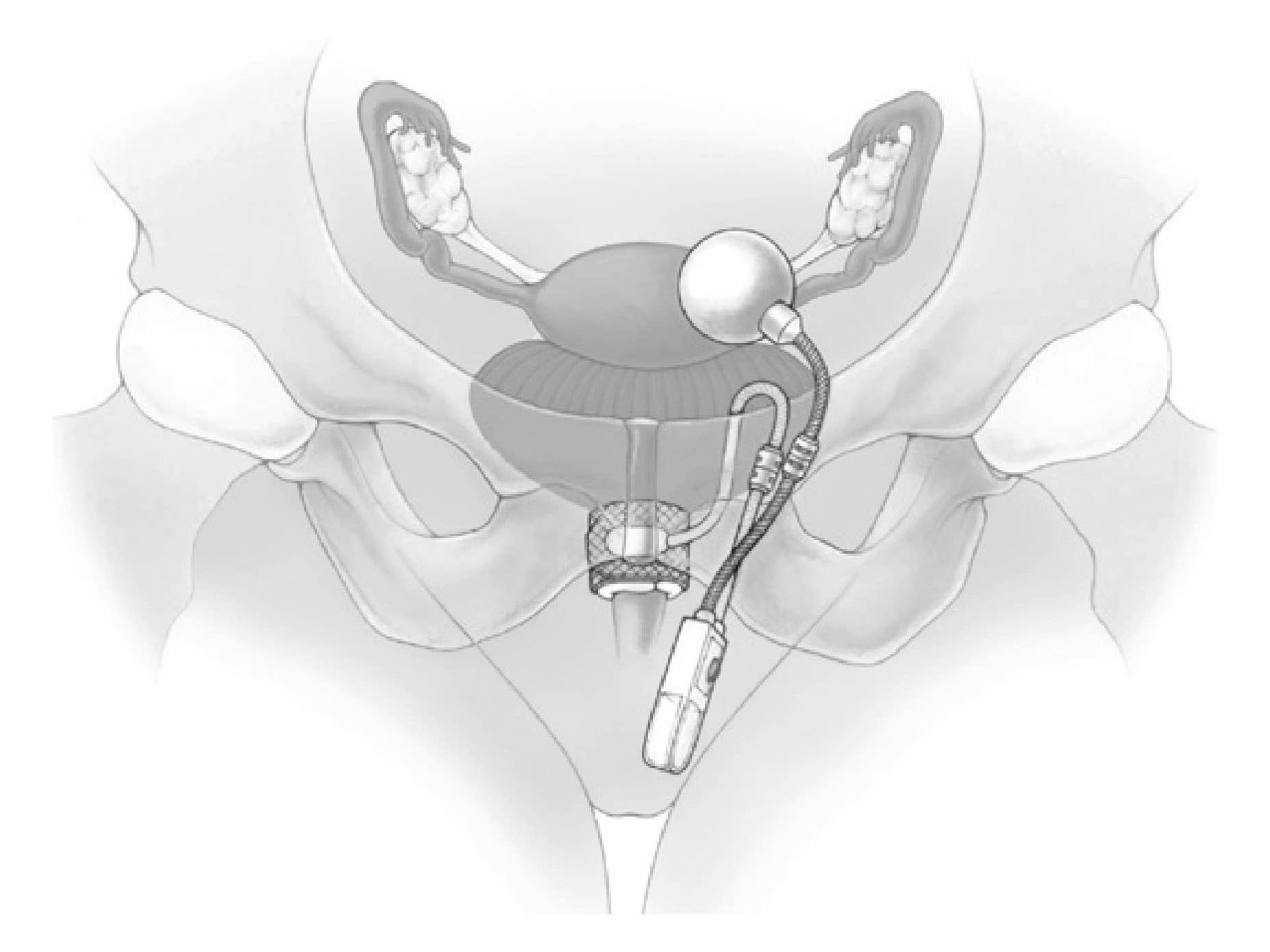 4 .sphincter artificiel urinaire ams 800 chez la femme 1