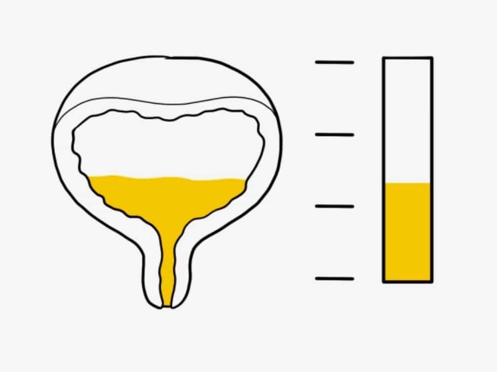 Hypertrophie de la prostate et sensation de vidange vésicale incomplète
