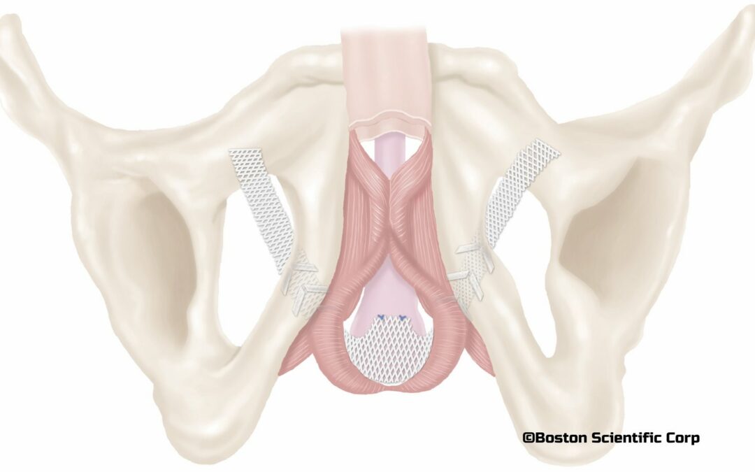 Comprendre l&rsquo;efficacité à long terme de la bandelette Advance XP pour l&rsquo;incontinence urinaire post-prostatectomie de faible importance ou modérée.