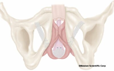 Comprendre l’efficacité à long terme de la bandelette Advance XP pour l’incontinence urinaire post-prostatectomie de faible importance ou modérée.