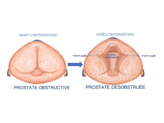 avant apres pose implants uriloft pdf avant apres pose implants uriloft pdf