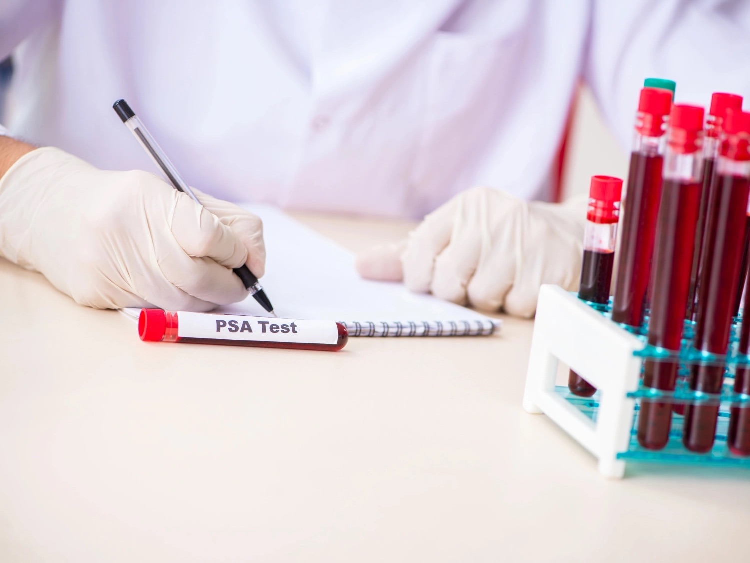 taux psa cancer prostate