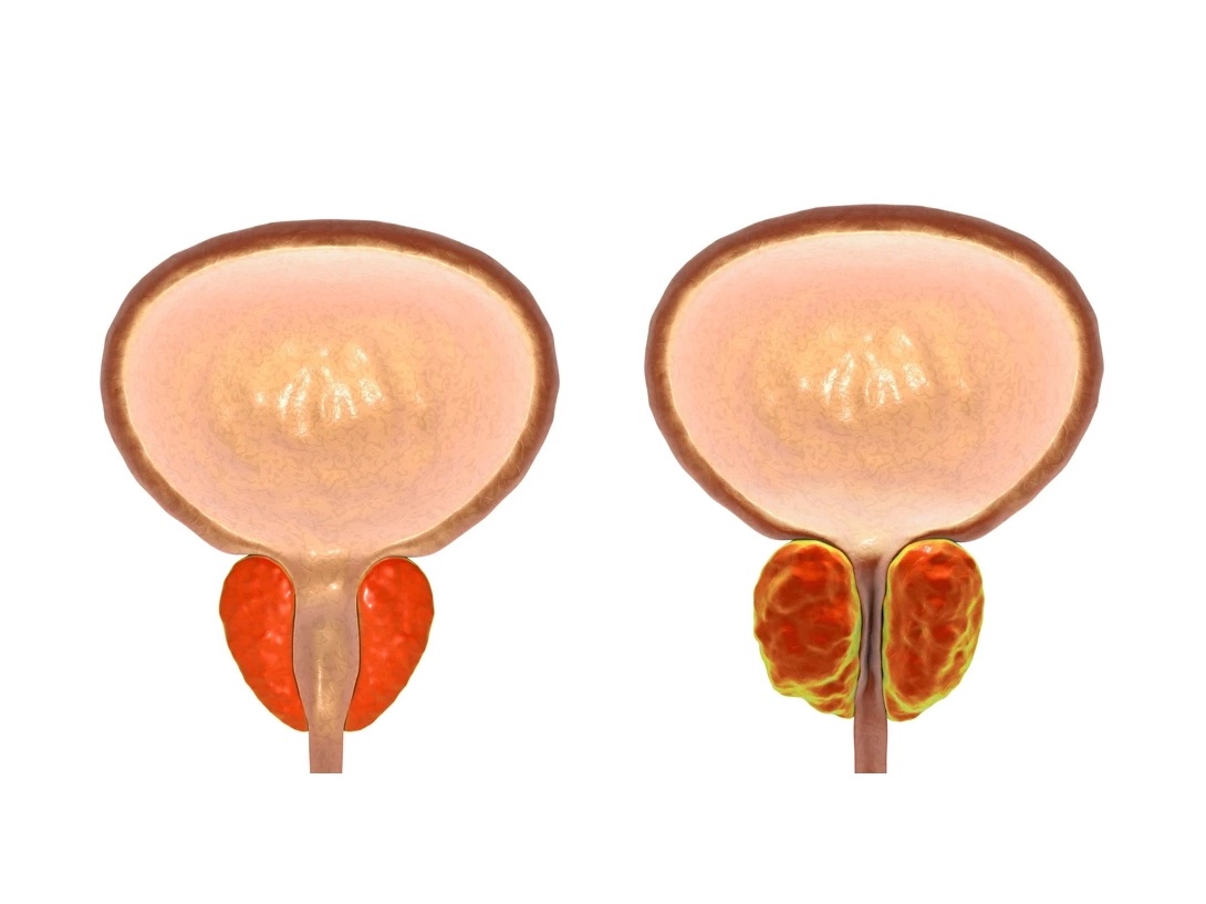 signe probleme prostate