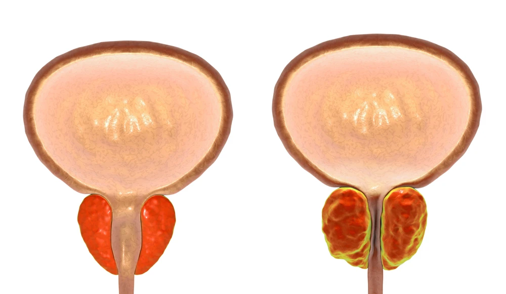 l'hypertrophie de la prostate peut être le signe de problèmes prostatiques
