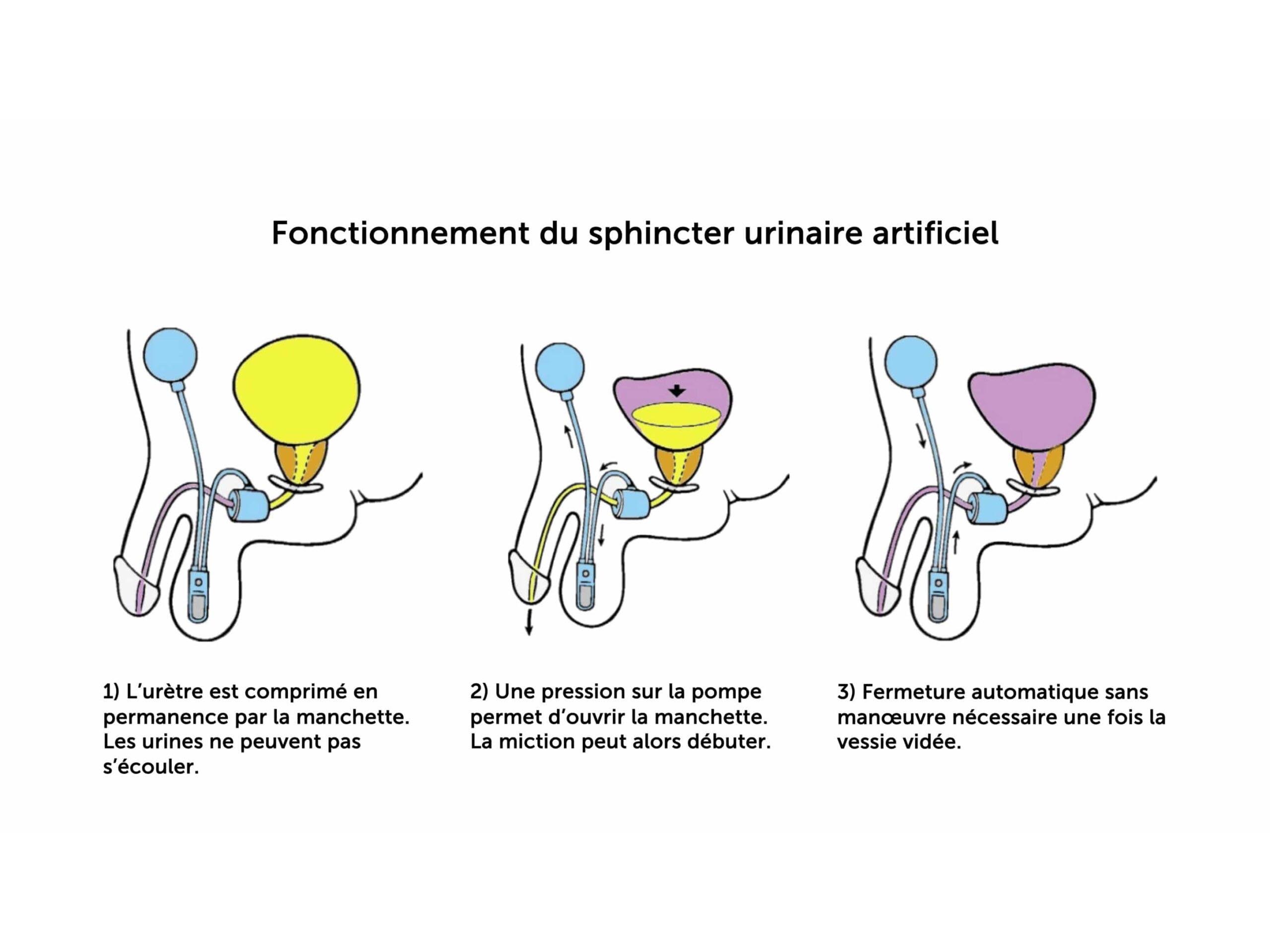 3. fonctionnement dun sphincter artificiel urinaire ams 800 final