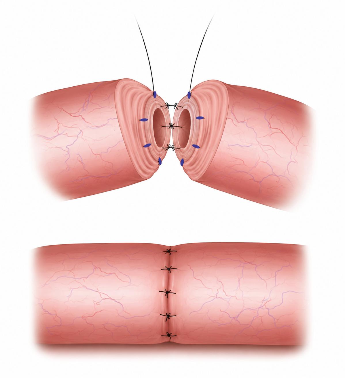 Vaso-vasostomieReversion de vasectomie