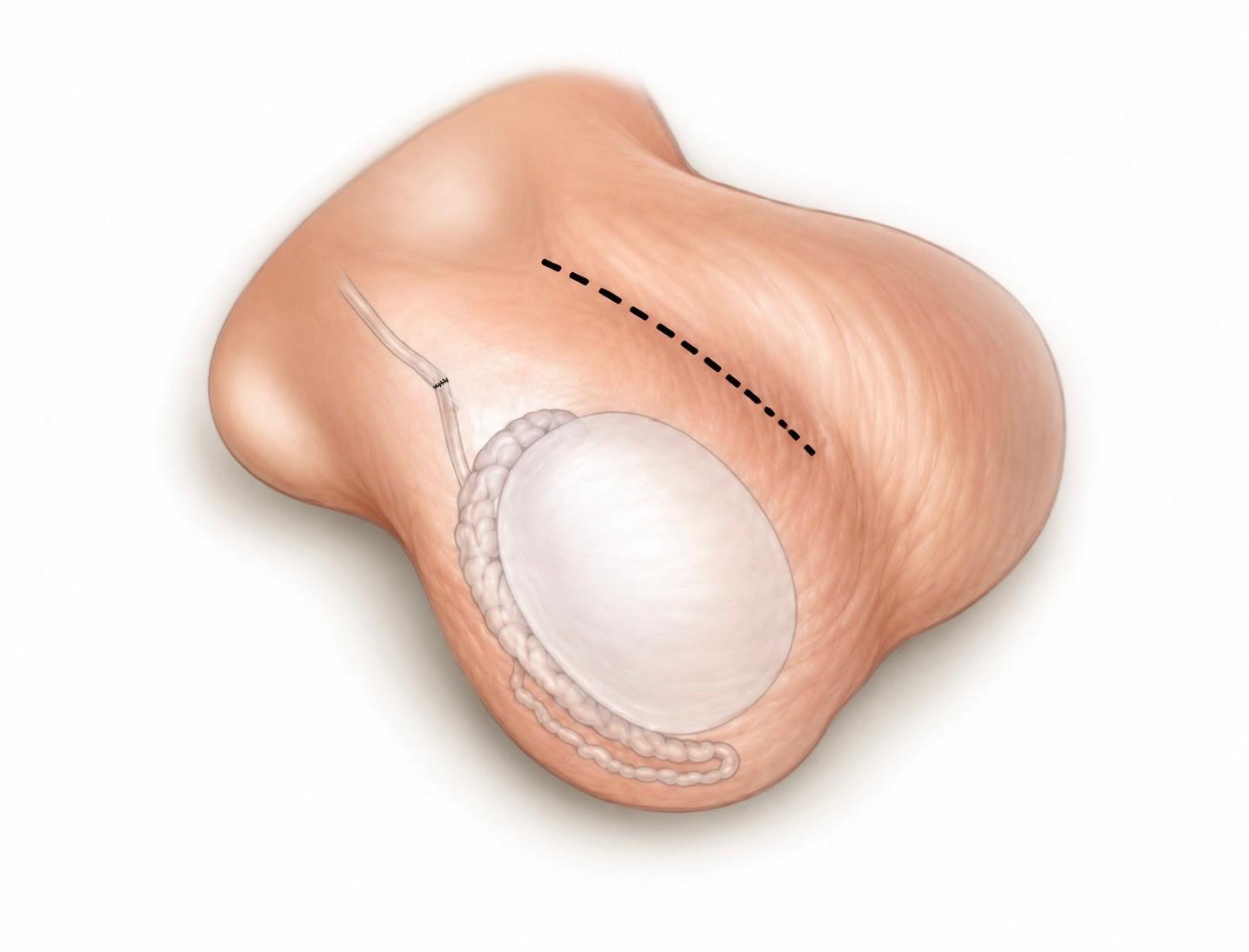 Abord chirurgical: Vaso-vasostomie - Reversion de vasectomie