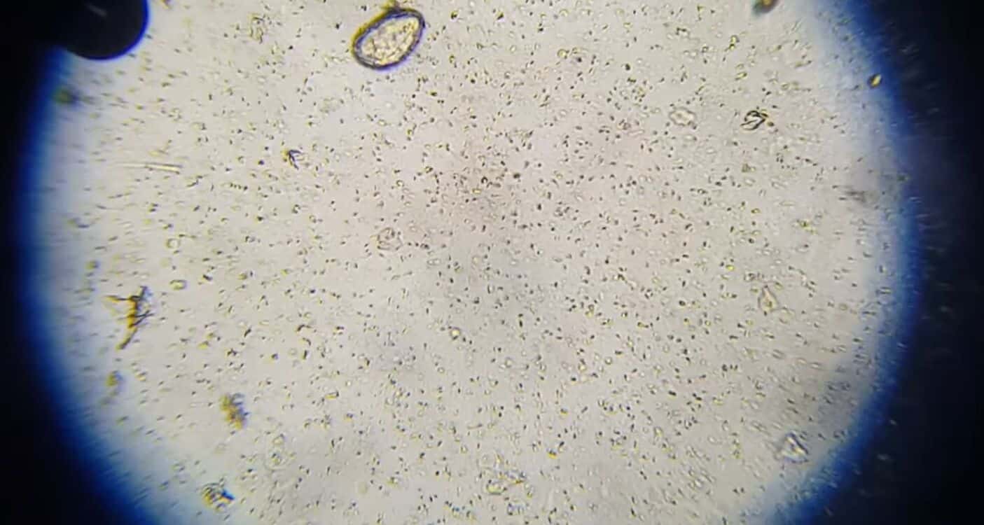 Spermatozoides après reversion de vasectomie au microscope