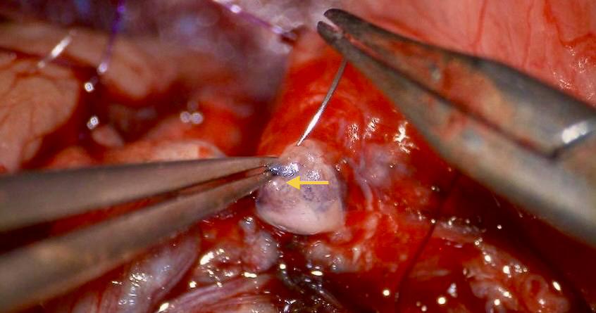 Lumière du conduit déférent de 0,3 mm lors d'une vasovasostomie.