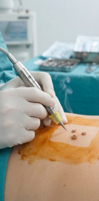Traitement des condylomes au laser CO2 à la clinique Ambroise Paré à Neuilly sur Seine