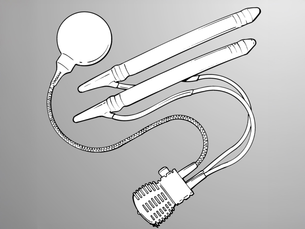 schéma d'un implant médical pour la prostate relié à deux stent pour le traitement de l'hyperplasie bénigne de la prostate