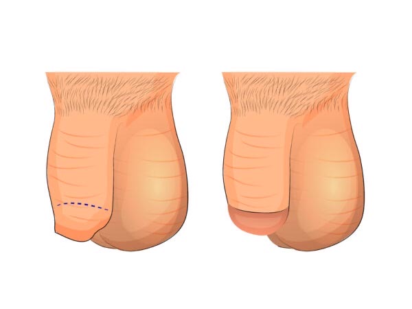 circumcision of the foreskin of the penis 600x400