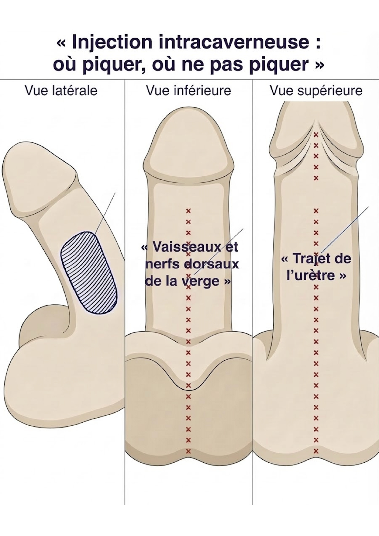Où ne pas injecter l'Edex?
