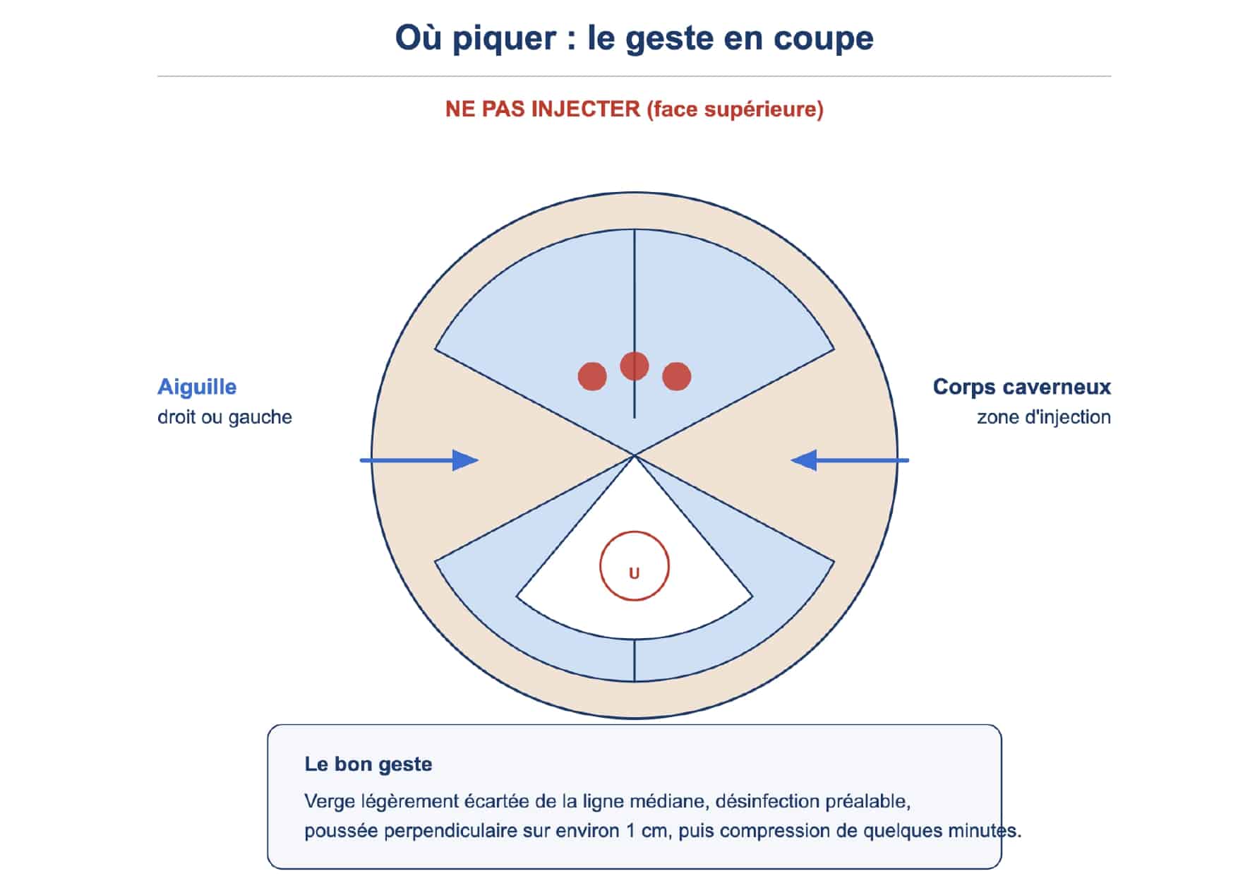 Où ne pas injecter l'Edex?