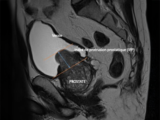 index protrusion prostatique (ipp) et blocage urinaire