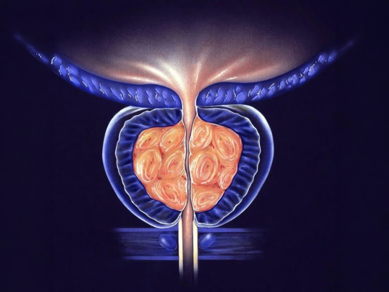 hypertrophie prostatique - adénome de la prostate