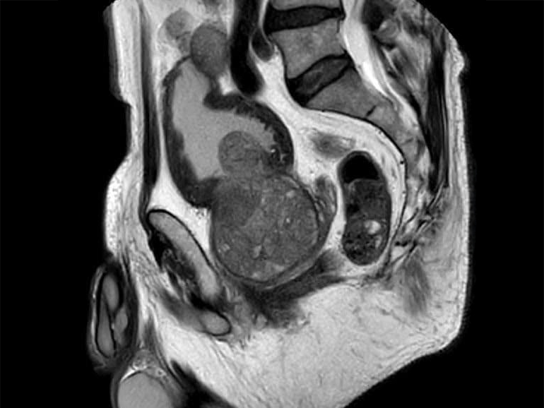 hypertrophie prostatique et vieillissement vue sur une échographie de la prostate d